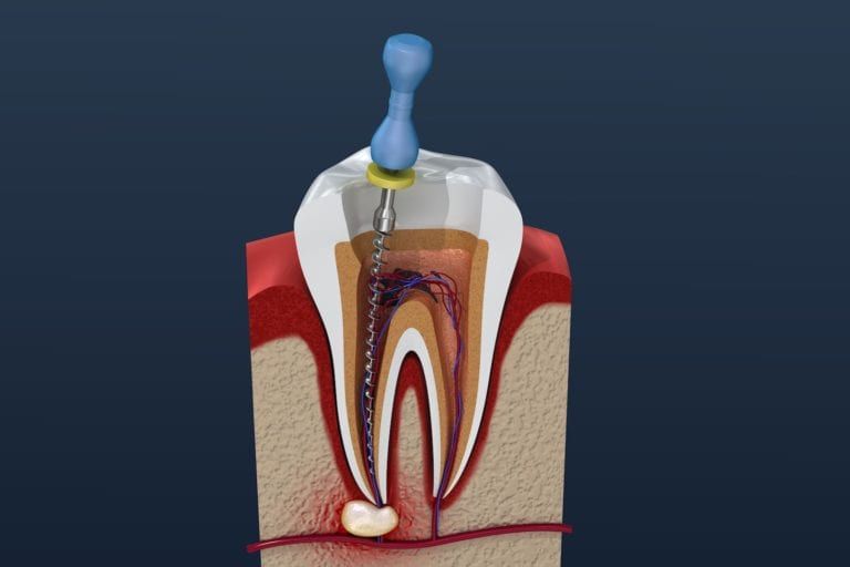 Root Canal Treatment Image