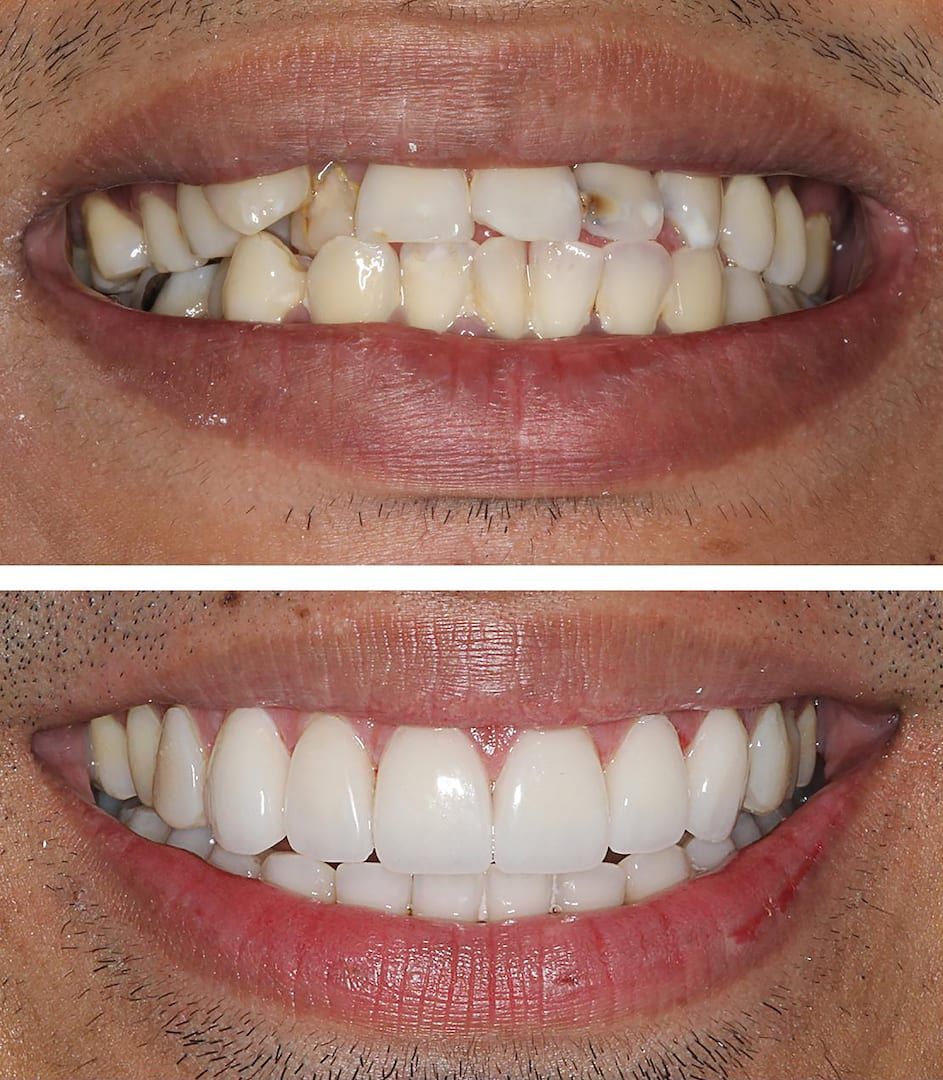 teeth before and after veneers