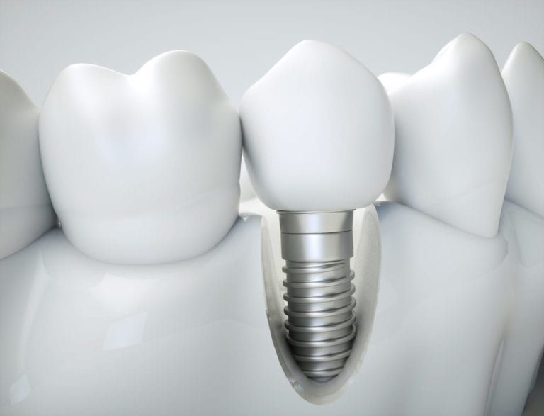 new teeth implant replacement image