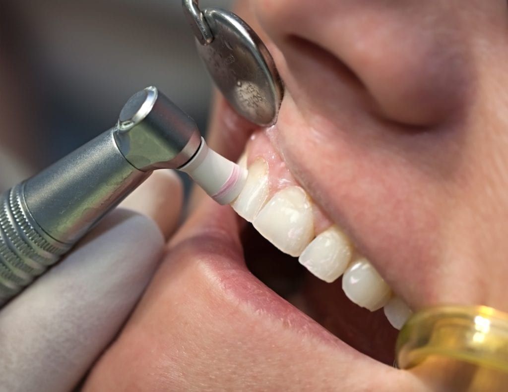 Closeup of a man having his teeth cleaned
