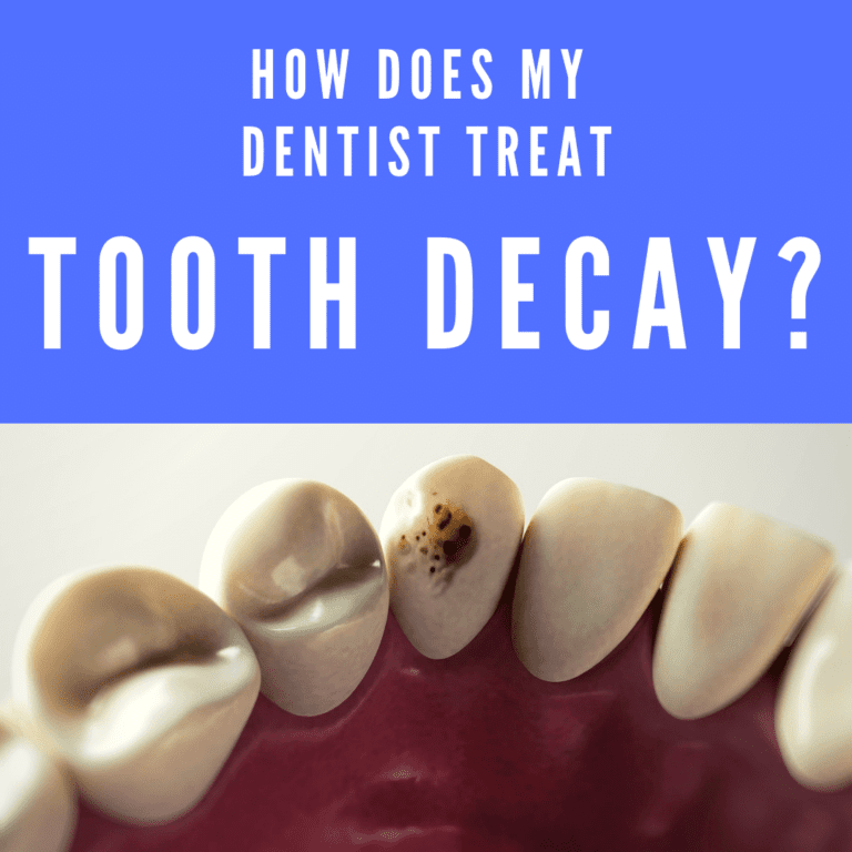 How Does my Dentist Treat Tooth Decay