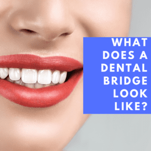 What do Dental Bridges Look Like_ (1)
