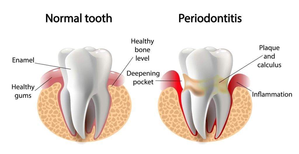 normal tooth vs. tooth surrounded by gum disease