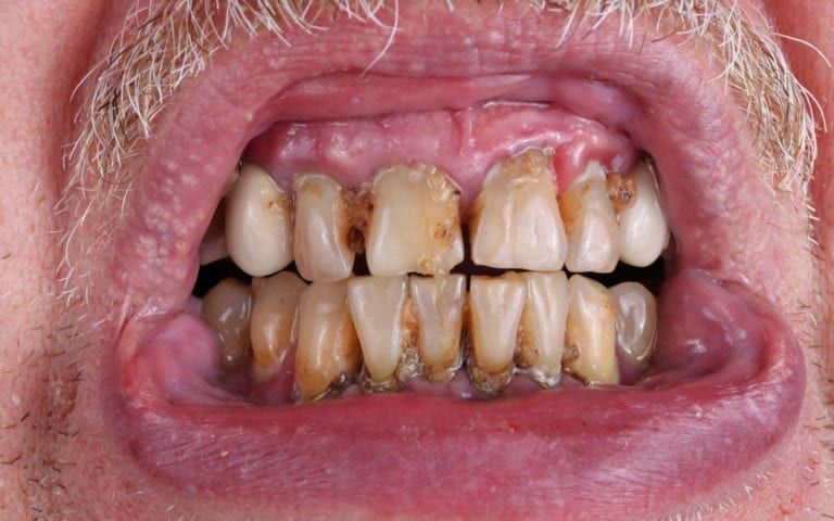 Man affected by periodontal disease