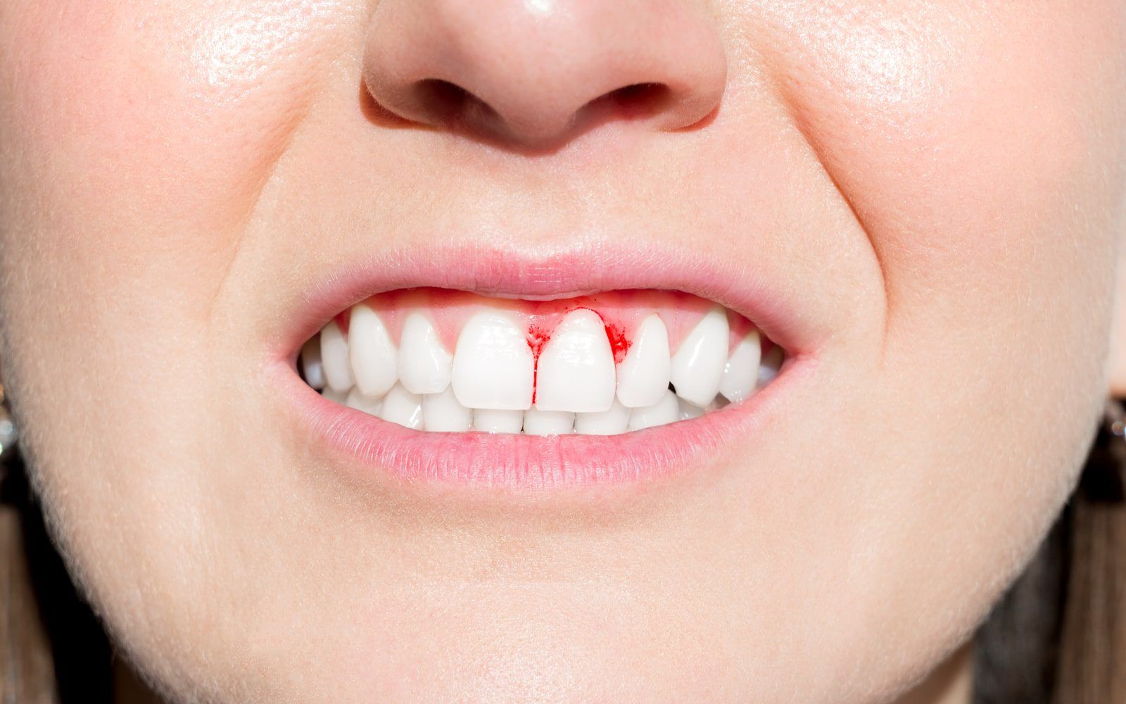 Why Bleeding Gums Are A Serious Cause For Concern McCartney Dental