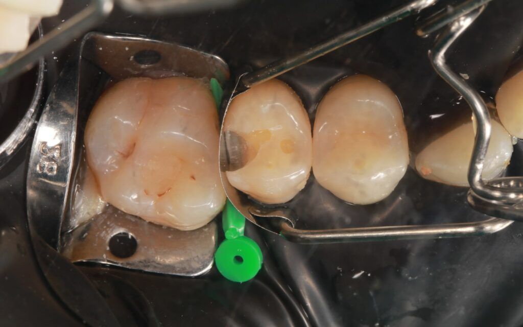 Discovering The GV Black Cavity Classification System - McCartney ...