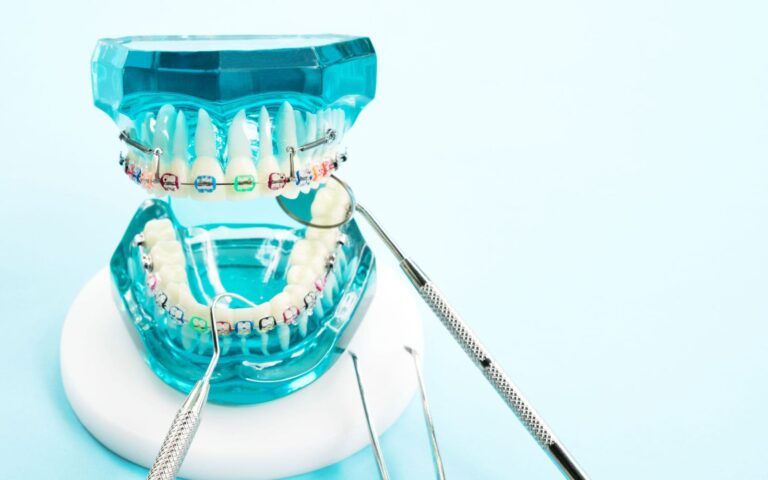 Blue Tooth Model of Braces